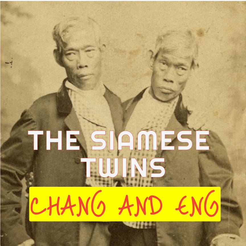 World's First Conjoined Twins: Siamese Twins - Dinosaur Facts